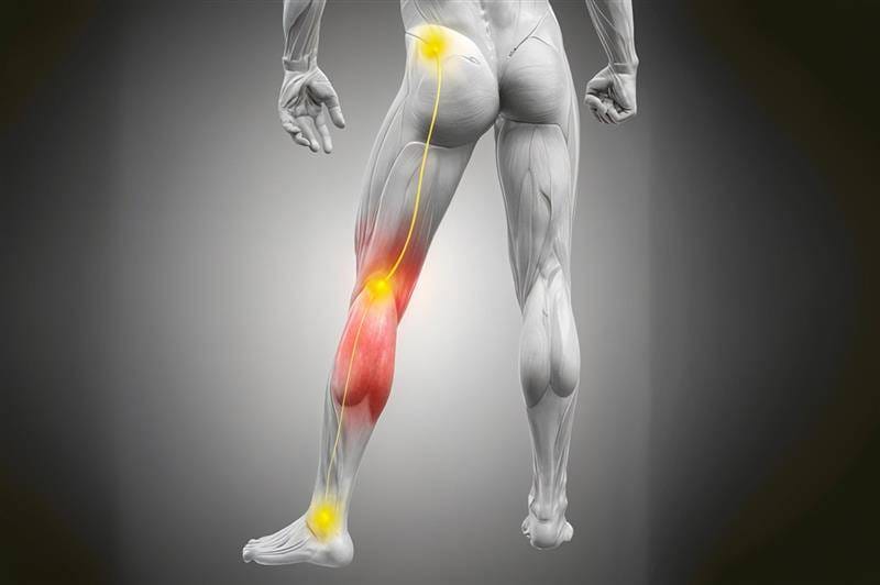 Sciatica pain treatment